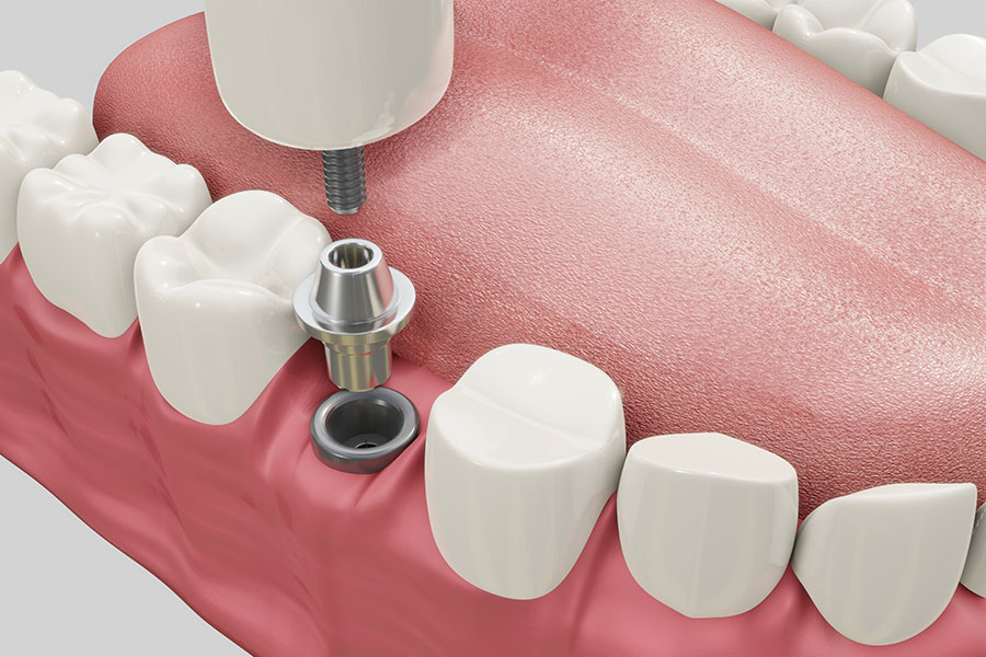 Dental Implants Treatment Procedure. Medically accurate 3D illus