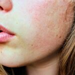 Vitiligo și provocarea repigmentării